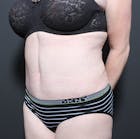 Tummy Tuck Before & After Gallery - Patient 14089683 - Image 2