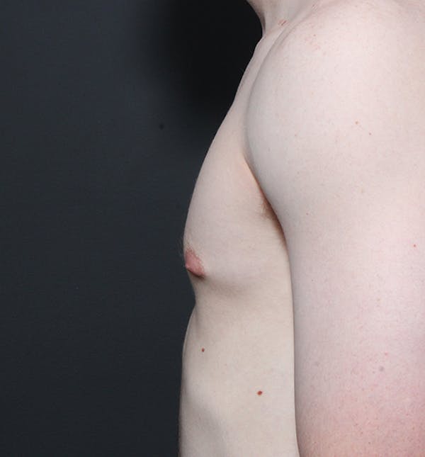 Male Chest Reduction Gallery - Patient 14089676 - Image 5