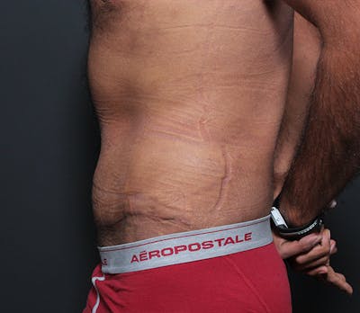 Male Tummy Tuck Before & After Gallery - Patient 14089675 - Image 6