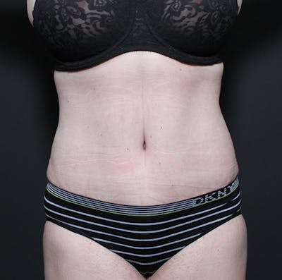 Tummy Tuck Before & After Gallery - Patient 14089683 - Image 4