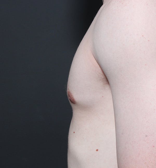 Male Chest Reduction Before & After Gallery - Patient 14089676 - Image 6