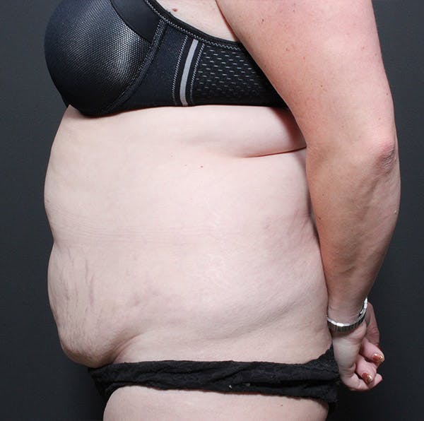 Tummy Tuck Before & After Gallery - Patient 14089683 - Image 5