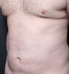 Male Chest Reduction Before & After Gallery - Patient 14089699 - Image 1