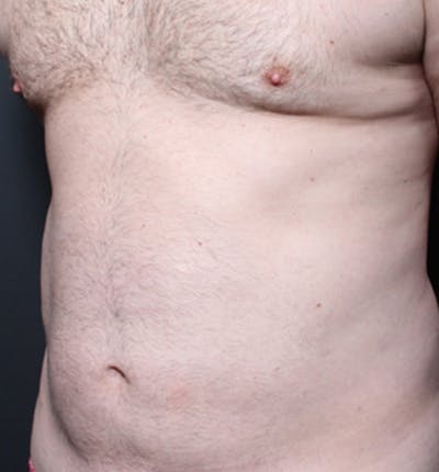 Male Chest Reduction Before & After Gallery - Patient 14089699 - Image 1