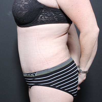 Tummy Tuck Before & After Gallery - Patient 14089683 - Image 6