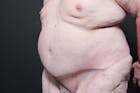 Male Tummy Tuck Before & After Gallery - Patient 14089682 - Image 2