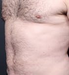 Male Chest Reduction Before & After Gallery - Patient 14089699 - Image 2