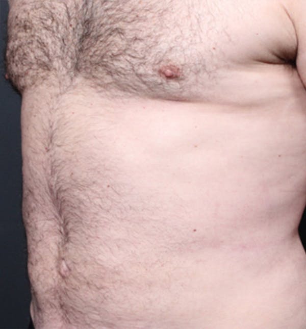 Male Chest Reduction Gallery - Patient 14089699 - Image 2