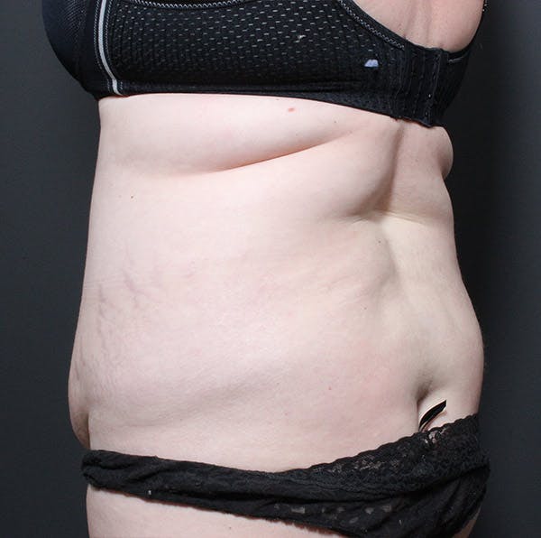 Tummy Tuck Before & After Gallery - Patient 14089683 - Image 7