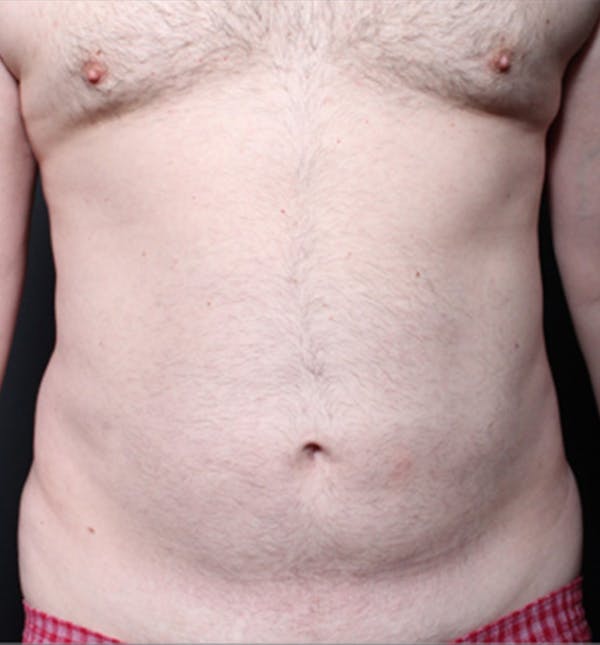 Male Chest Reduction Before & After Gallery - Patient 14089699 - Image 3