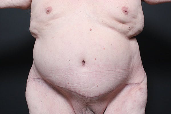 Male Tummy Tuck Before & After Gallery - Patient 14089682 - Image 4