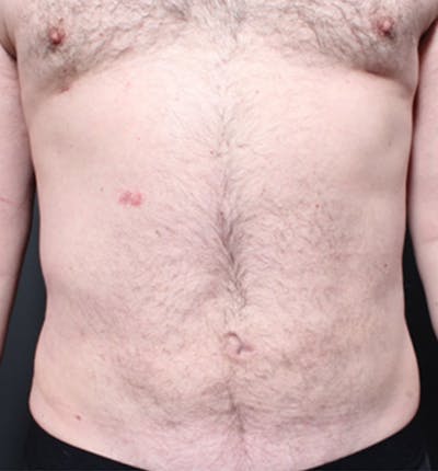 Male Chest Reduction Before & After Gallery - Patient 14089699 - Image 4