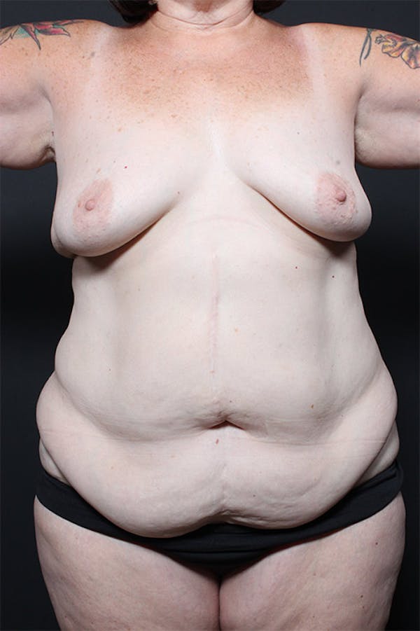 Liposuction Before & After Gallery - Patient 14089686 - Image 3