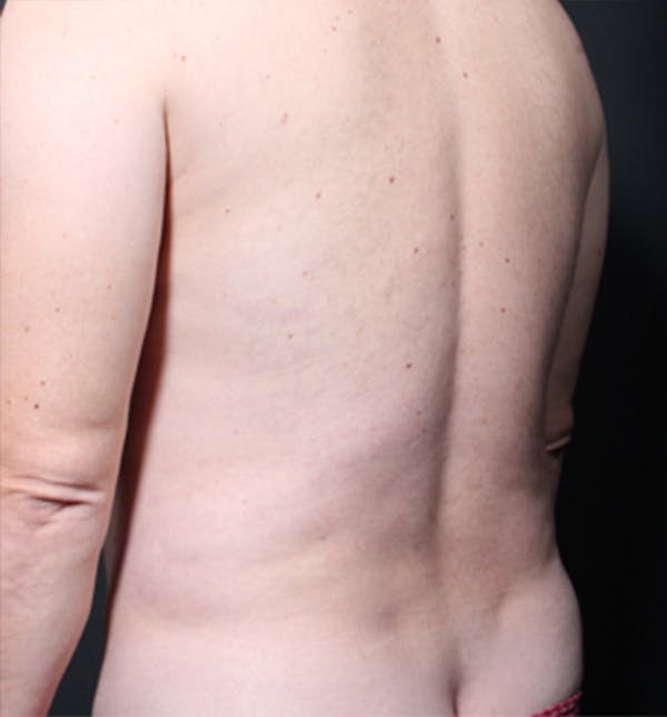 Male Chest Reduction Before & After Gallery - Patient 14089699 - Image 5