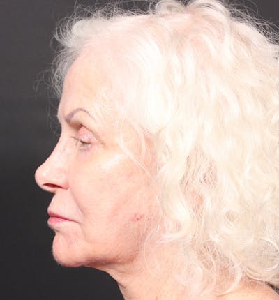 Injectables Before & After Gallery - Patient 14089691 - Image 6