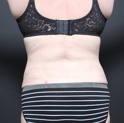 Tummy Tuck Before & After Gallery - Patient 14089683 - Image 10