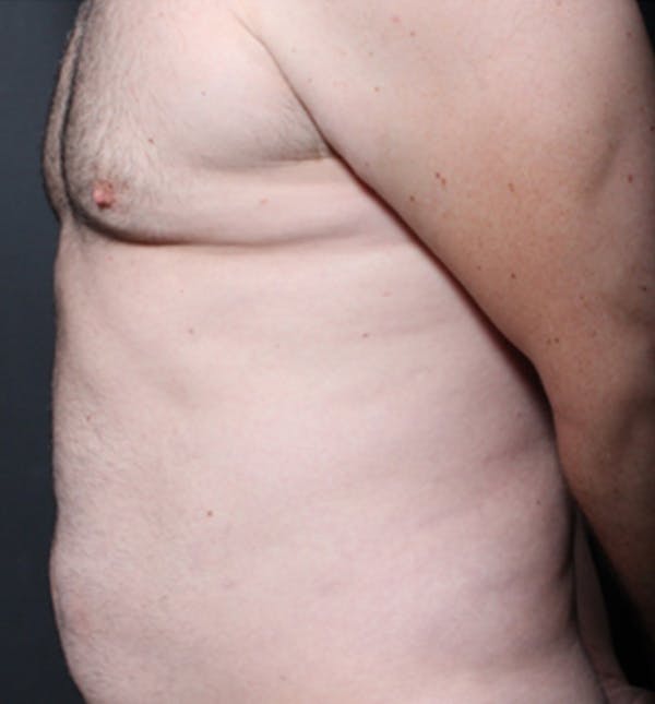 Male Chest Reduction Before & After Gallery - Patient 14089699 - Image 7
