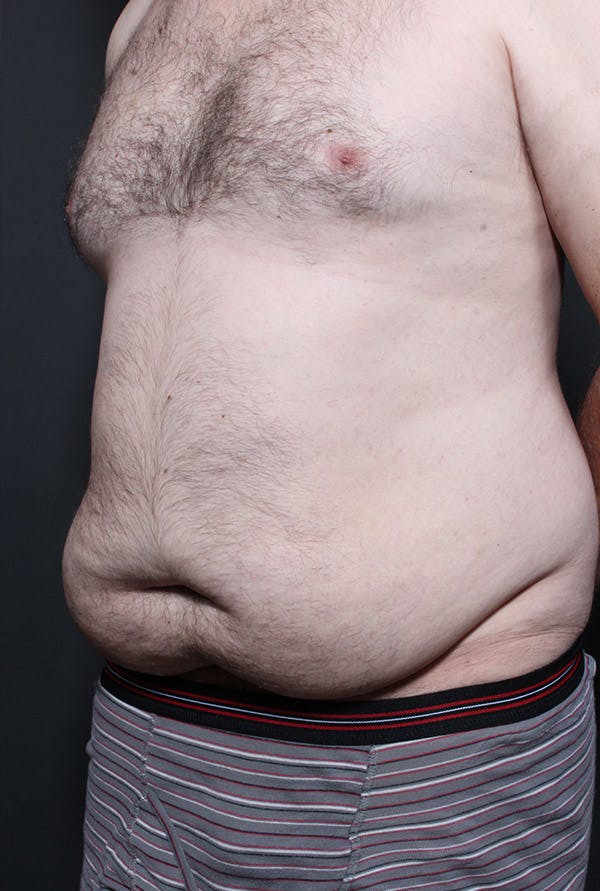 Male Tummy Tuck Before & After Gallery - Patient 14089694 - Image 1