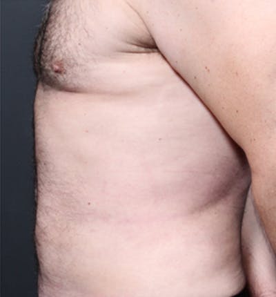 Male Chest Reduction Before & After Gallery - Patient 14089699 - Image 8