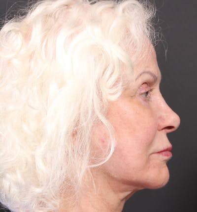 Injectables Before & After Gallery - Patient 14089691 - Image 8
