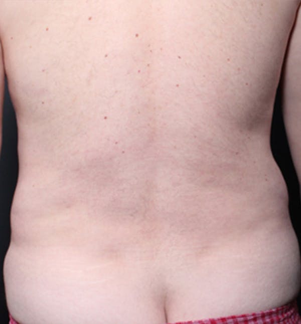 Male Chest Reduction Before & After Gallery - Patient 14089699 - Image 9