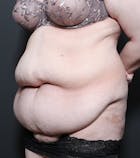 Liposuction Gallery - Patient 14089696 - Image 1