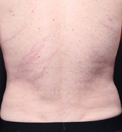Male Chest Reduction Before & After Gallery - Patient 14089699 - Image 10