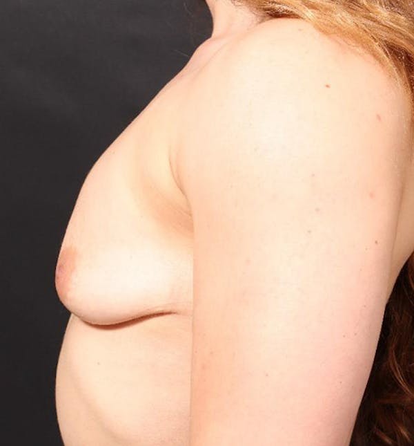 Breast Augmentation Before & After Gallery - Patient 14089689 - Image 5