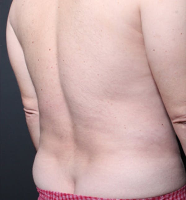 Male Chest Reduction Before & After Gallery - Patient 14089699 - Image 11