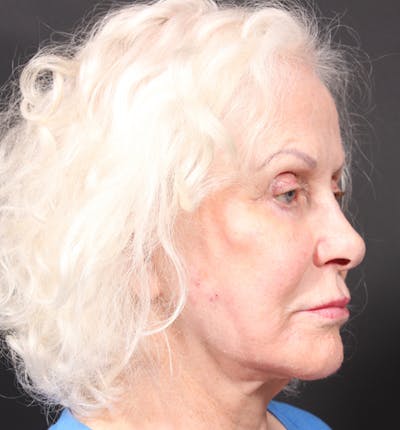 Injectables Before & After Gallery - Patient 14089691 - Image 10
