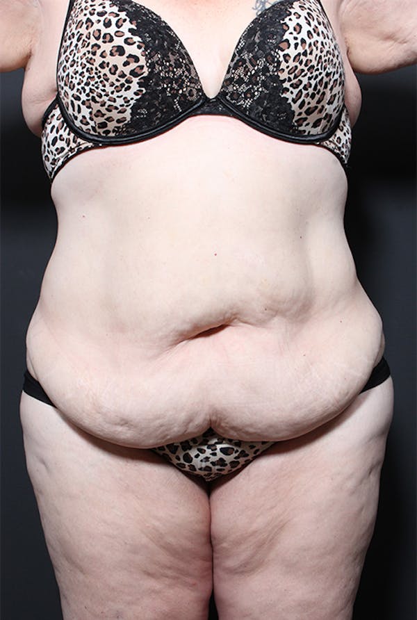 Plus Size Tummy Tuck® Before & After Gallery - Patient 14089702 - Image 1