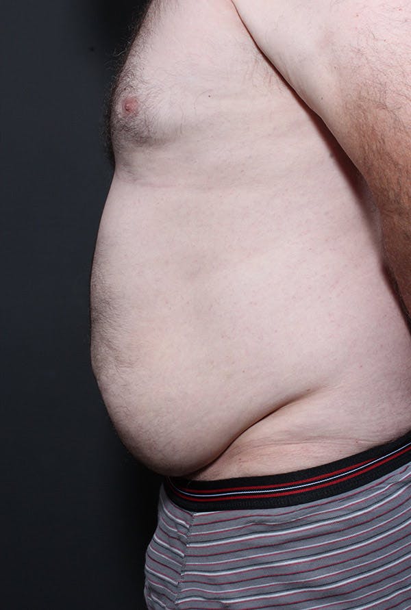 Male Tummy Tuck Before & After Gallery - Patient 14089694 - Image 5