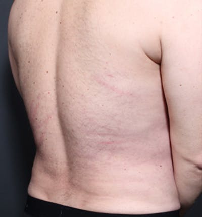 Male Chest Reduction Before & After Gallery - Patient 14089699 - Image 12