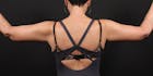 Arm Lift Before & After Gallery - Patient 14089698 - Image 2