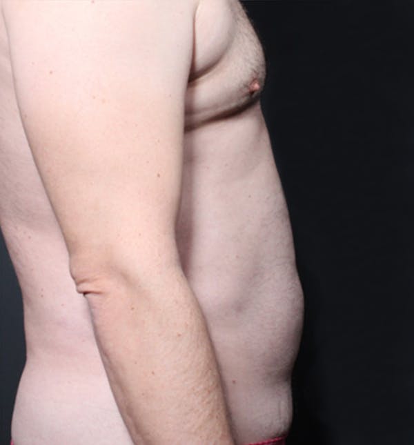 Male Chest Reduction Before & After Gallery - Patient 14089699 - Image 13
