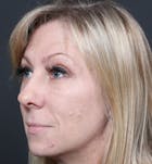 Injectables Before & After Gallery - Patient 14089714 - Image 1