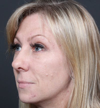 Injectables Before & After Gallery - Patient 14089714 - Image 1