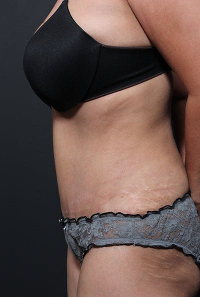 Tummy Tuck Before & After Gallery - Patient 14089695 - Image 6