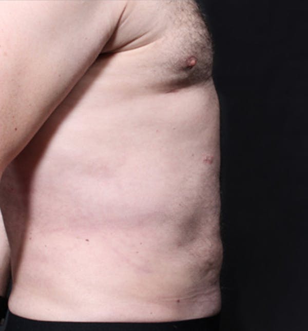 Male Chest Reduction Before & After Gallery - Patient 14089699 - Image 14