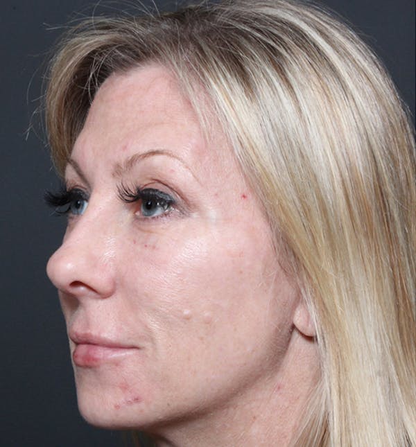 Injectables Before & After Gallery - Patient 14089714 - Image 2