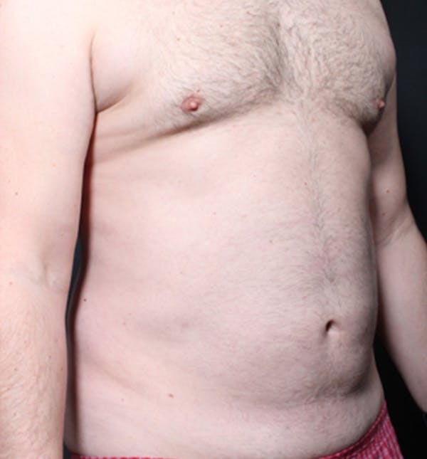 Male Chest Reduction Before & After Gallery - Patient 14089699 - Image 15
