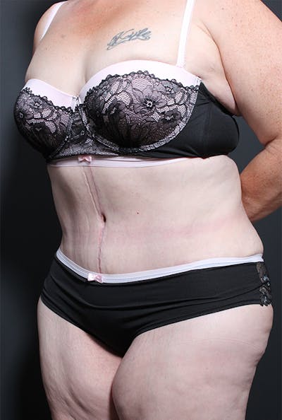 Plus Size Tummy Tuck® Before & After Gallery - Patient 14089702 - Image 4