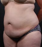 Liposuction Before & After Gallery - Patient 14089708 - Image 1