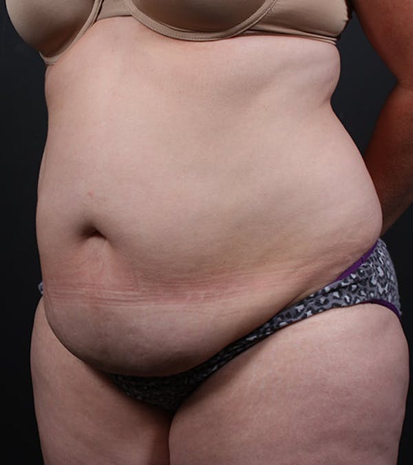 Liposuction Before & After Gallery - Patient 14089708 - Image 1