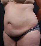 Liposuction Gallery - Patient 14089708 - Image 1
