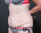 Tummy Tuck Before & After Gallery - Patient 14089705 - Image 1
