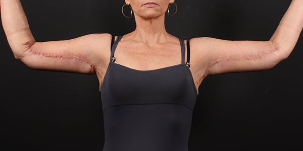 Arm Lift Before & After Gallery - Patient 14089698 - Image 4