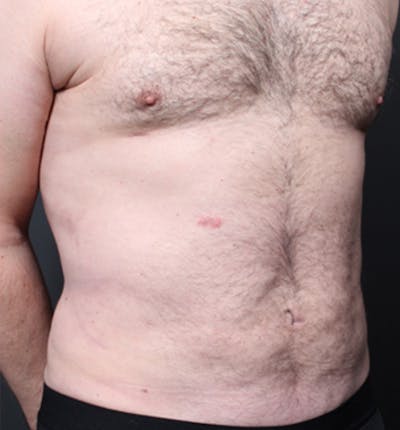 Male Chest Reduction Before & After Gallery - Patient 14089699 - Image 16