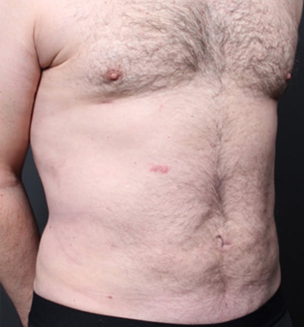 Male Chest Reduction Before & After Gallery - Patient 14089699 - Image 16