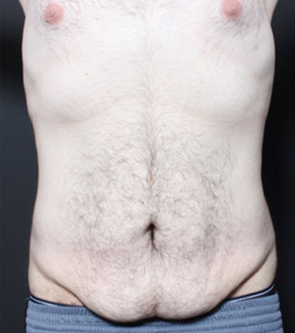 Male Tummy Tuck Before & After Gallery - Patient 14089711 - Image 3
